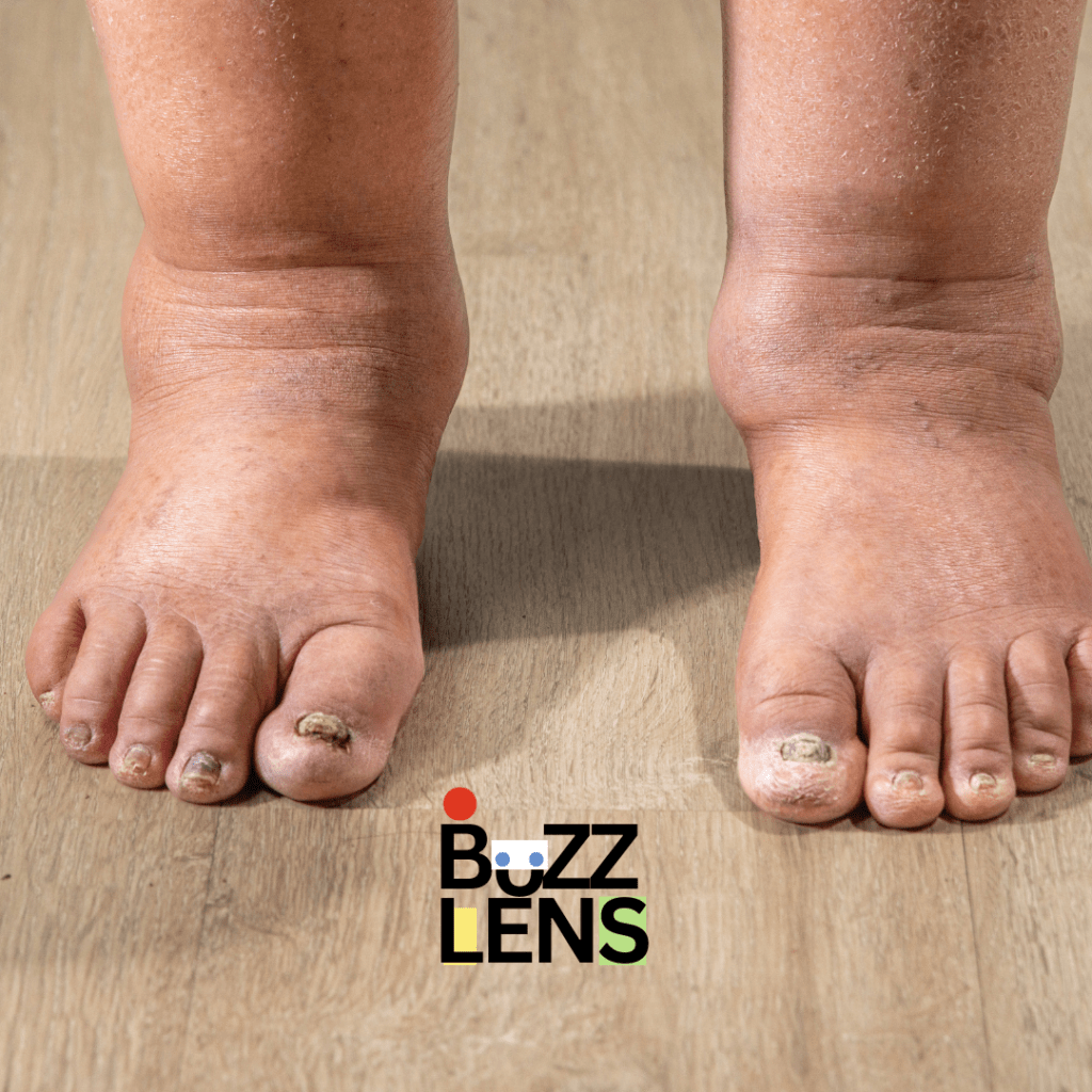 Swelling and Color Changes in Your Feet or Legs