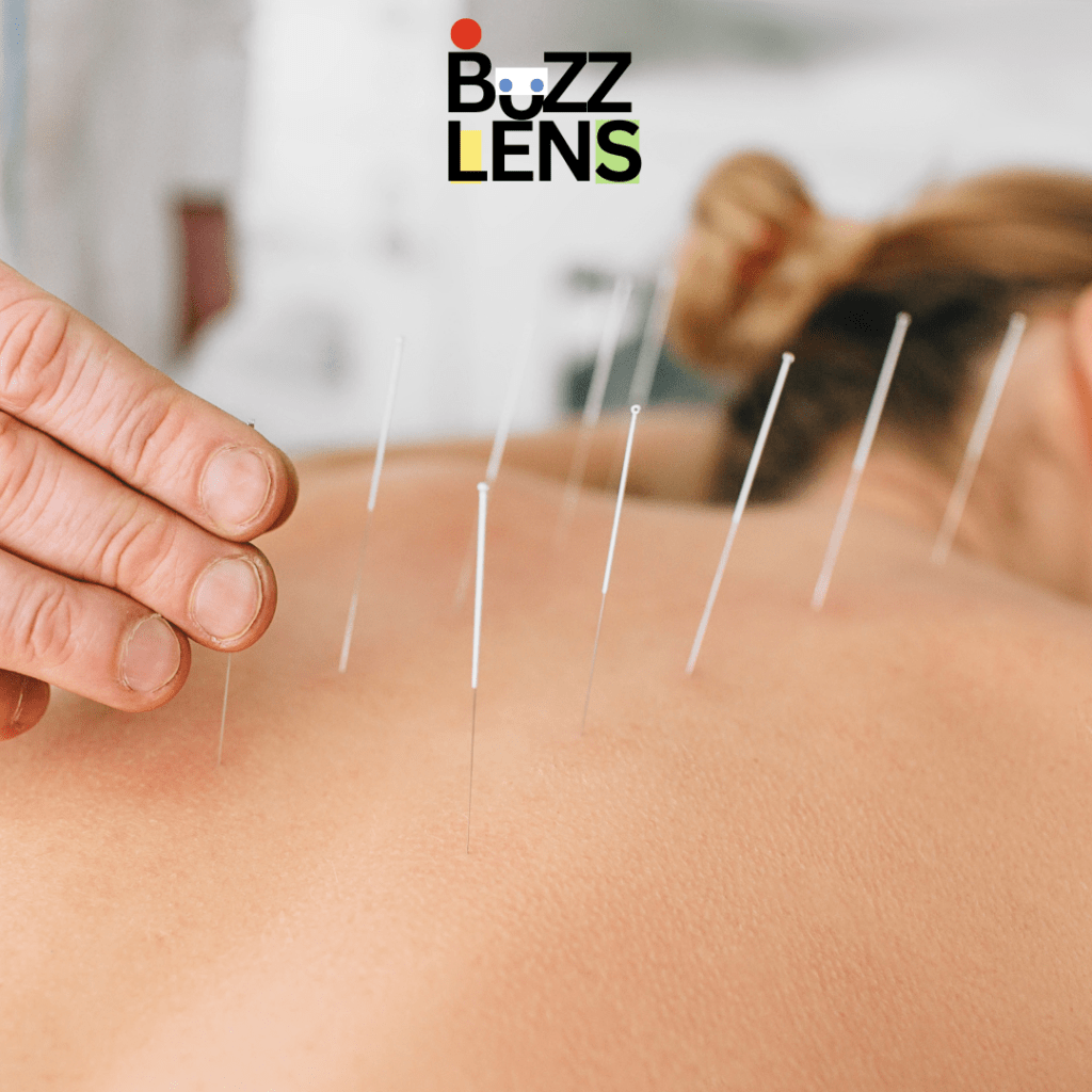 Acupuncture