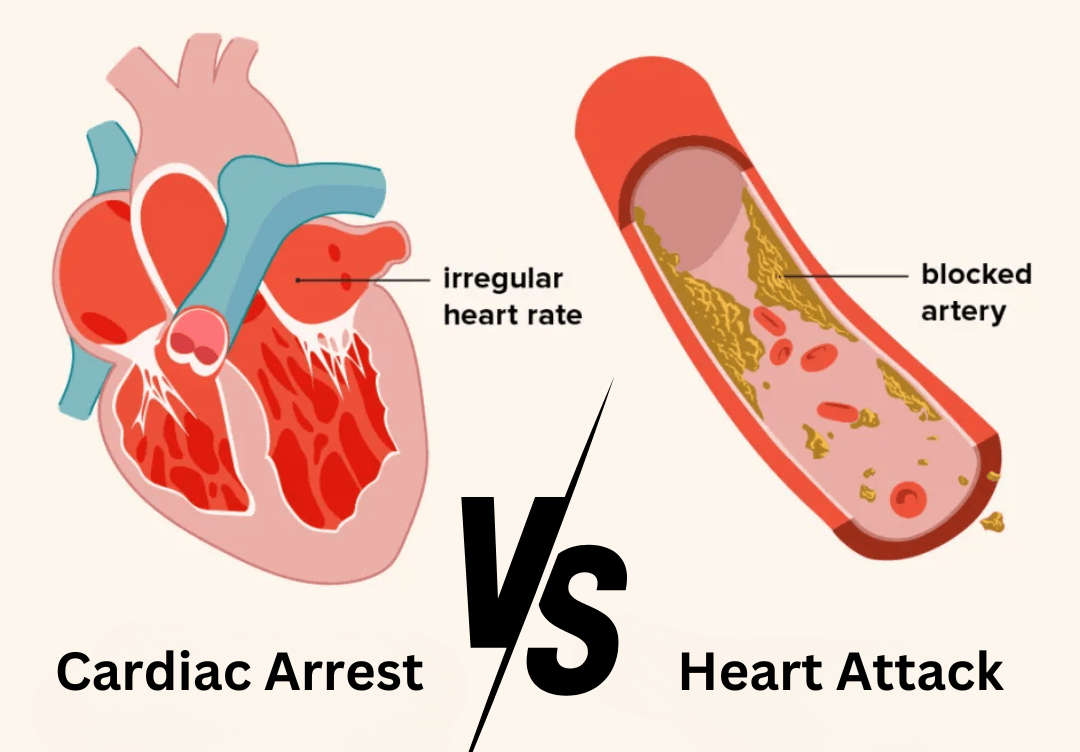 Cardiac Arrest vs. Heart Attack: Understanding the Differences and Health Implications